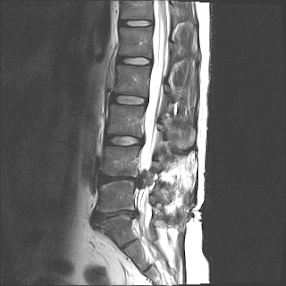 /images/2017-08-lumbar-mri.png